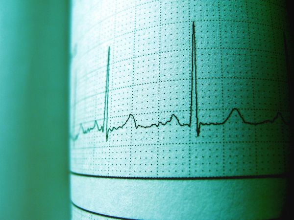 Parcours "Insuffisance cardiaque"